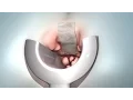 Hemorrhoid Removal Hemorrhoidectomy