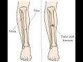 Fracture Closed treatment of Tibial and Fibular CPT code - simplify medical coding