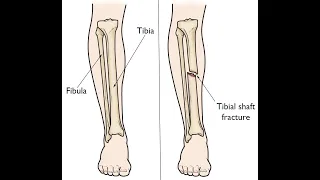 Fracture Closed treatment of Tibial and Fibular CPT code - simplify medical coding