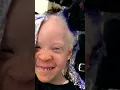 Unbelievable Transformation of Albino Girl