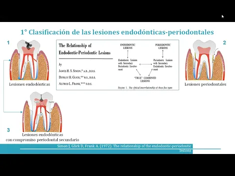 Download MP3 Lesiones endodónticas periodontales  II