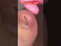 Download Lagu YOU MAY NOT BELIEVE THE SIZE OF THIS INGROWN TOENAIL🤯#shorts