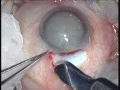 Download Lagu Mature cataract SICS - Dr Prathmesh Mehta.mpg