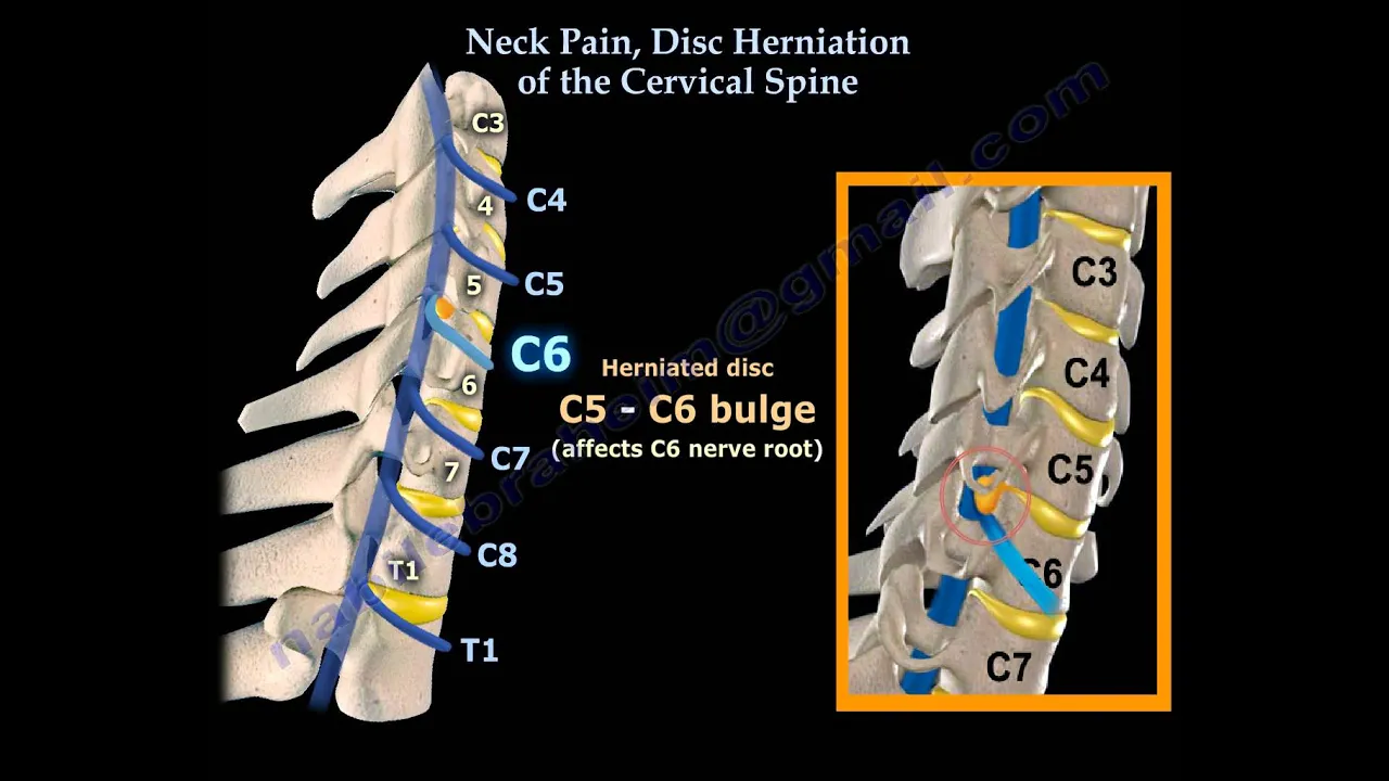 How to Read X-rays of the Lumbar Spine (Lower Back) | Spine Surgeon Colorado. 