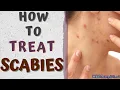 HOW TO TREAT treatment at home