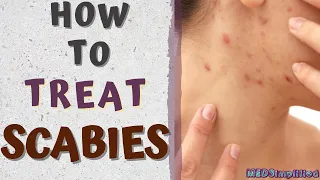 Download HOW TO TREAT SCABIES/scabies treatment at home MP3