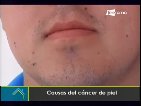 Causas del cáncer de piel