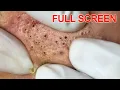 Blackheads removal - Best Pimple Popping s