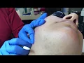 Electrolysis Thermolysis Technique On The Face - ElectroYogi Electrolysis