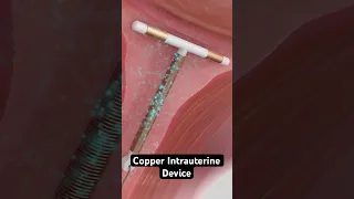 Copper IUD Birth Control 3D Animation