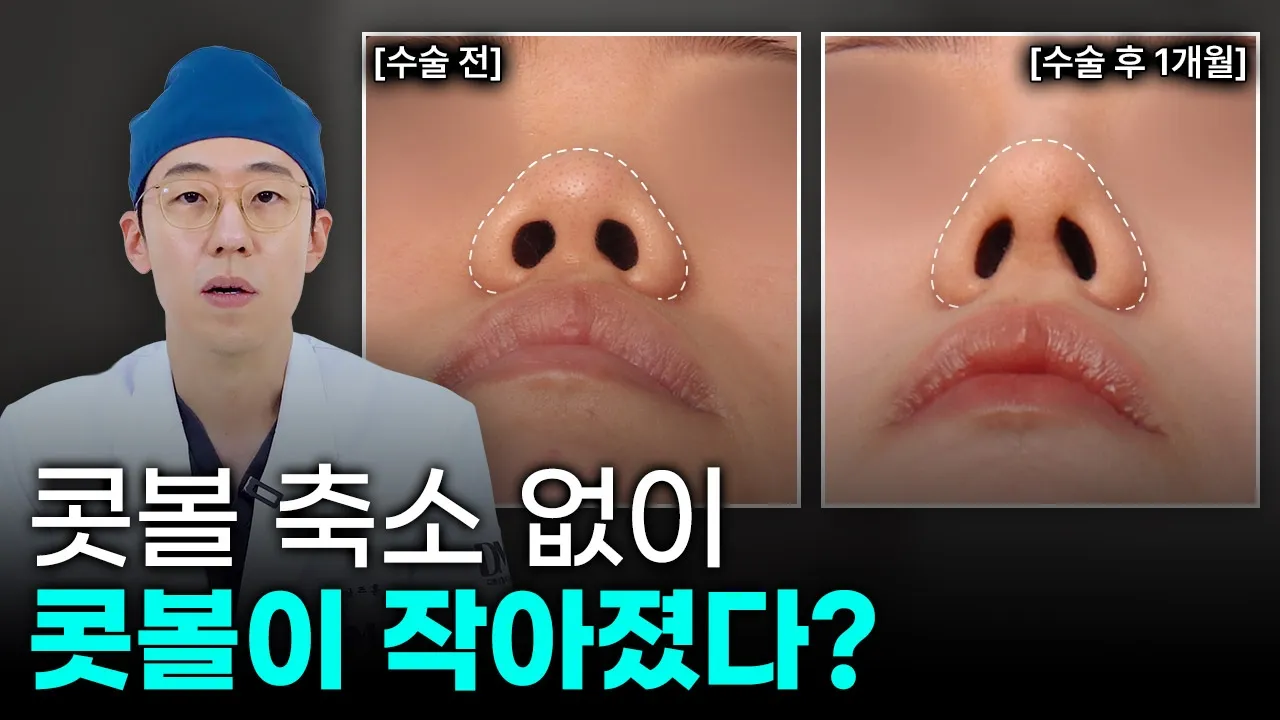 콧볼 축소 안 했는데 콧볼이 작아 보이는 이유?(4K)