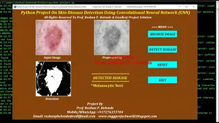 Skin Disease Detection Using CNN Python OpenCV Keras Project Source Code