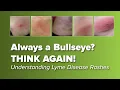 Think the Lyme Disease Rash is Always a Bull s-eye Think Again Johns Hopkins Rheumatology