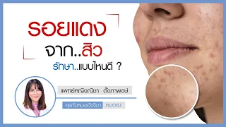 รอยแดงและรอยดำจากสิวเกิดจากอะไร และรักษาอย่างไรได้บ้าง