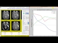 Brain Tumor Detection using Convolutional Neural Network CNN