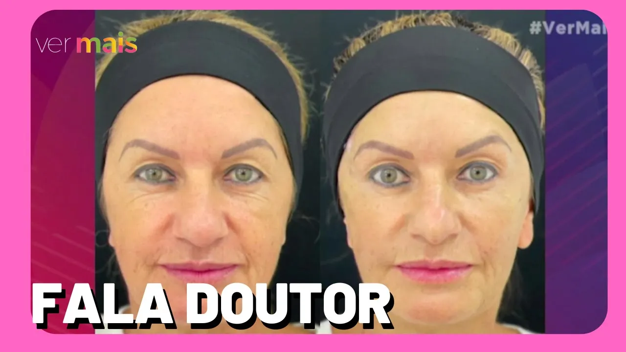 Fala Doutor: conheça o mini lifting temporal