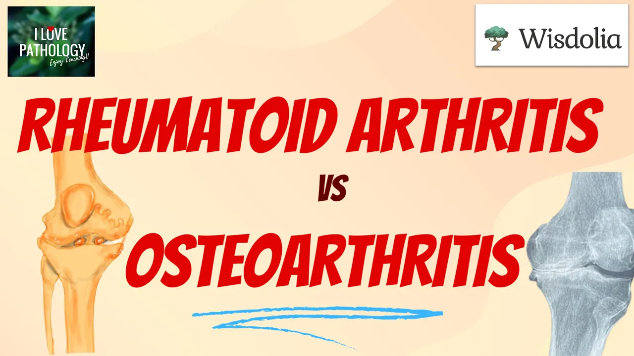 Rheumatoid Arthritis Vs Osteoarthritis