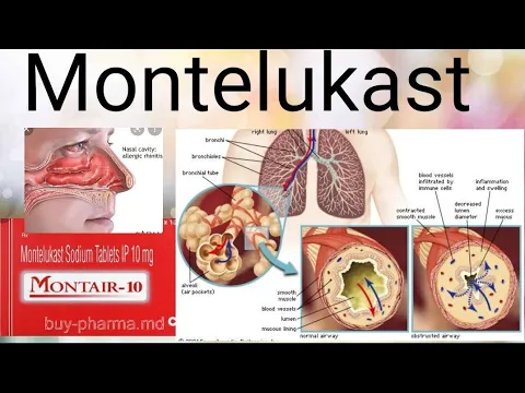 Download MP3 Montelukast: Drug for Allergic Rhinitis..