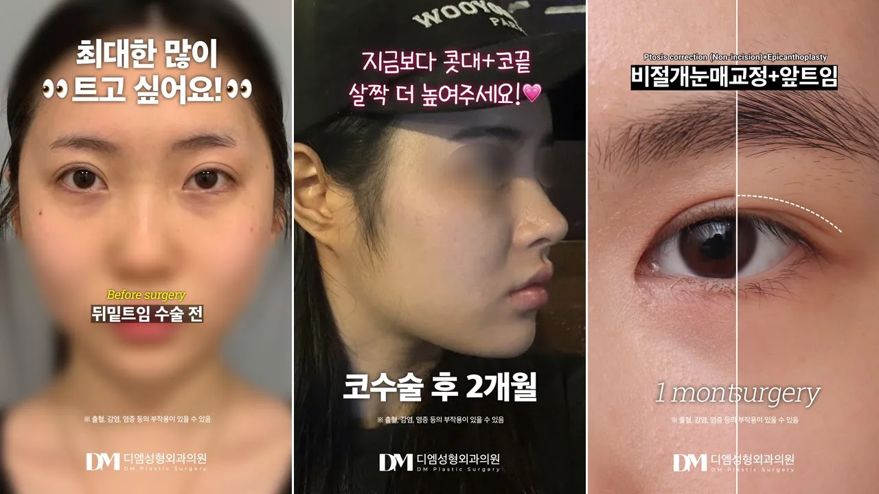 자연스럽게 예뻐지는 방법 | 성형 쇼츠 모음▶️