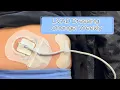 LVAD Dressing Change Weekly