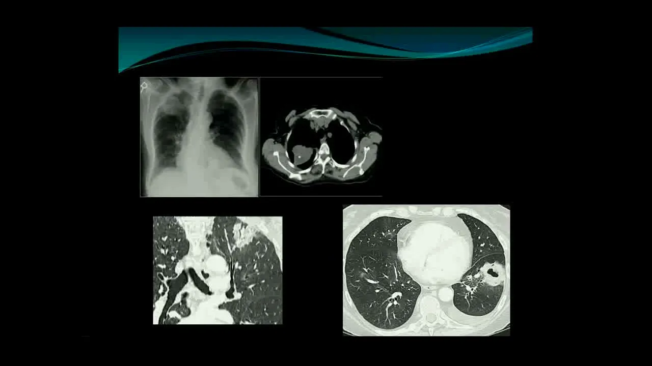 CT lung nodules and ILD