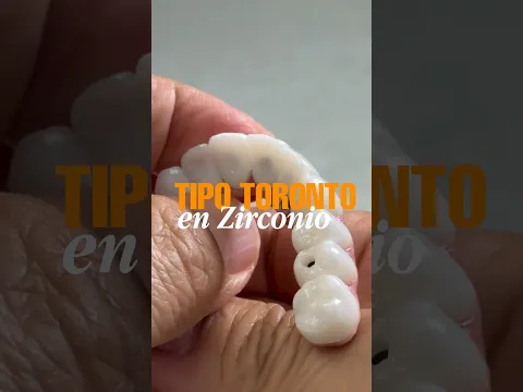 Prótesis híbridas sobre implantes tipo Toronto en titanio y zirconio