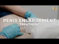 NON-SURGICAL PENIS ENLARGEMENT with Dermal Fillers