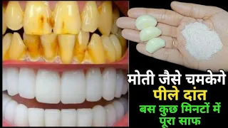 लहसुन की सिर्फ 4 कलियाँ : पीले-गंदे दांतों को मोती की तरह चमका देगा ये नुस्खा - White Teeth at Home