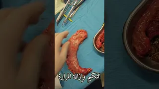 تكميم المعدة وإزالة المرارة 