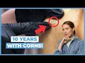 Say Goodbye to Foot Pain with This Simple Solution Corn Removal