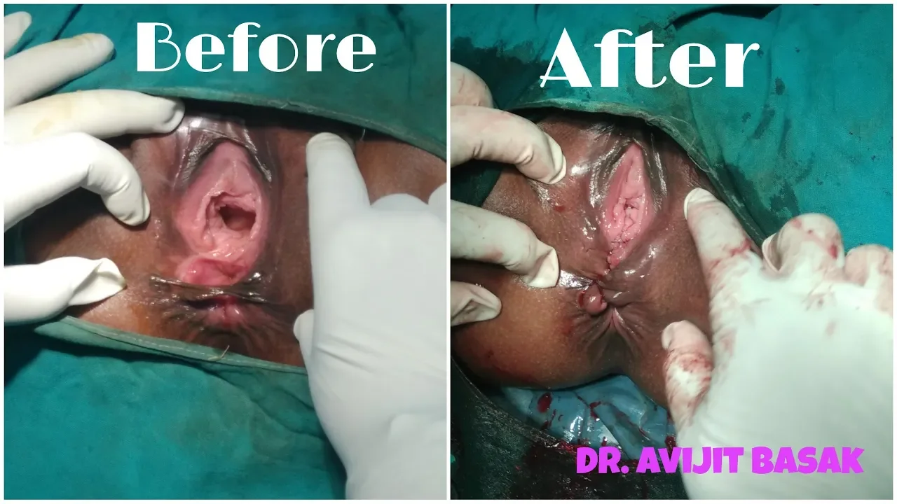 Complete Perineal Tear Repair by Dr.Avijit Basak
