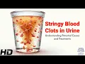Download Lagu Stringy Blood Clots in Your Urine? Here’s What It Could Mean