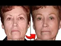 Is CO2 Fractional Laser Resurfacing WORTH IT Plastic Surgeon Answers