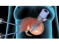 Cholecystectomy Gallbladder Removal Surgery Nucleus Health