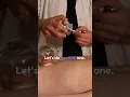 Fire Cupping Demonstration Glass Cups in Use