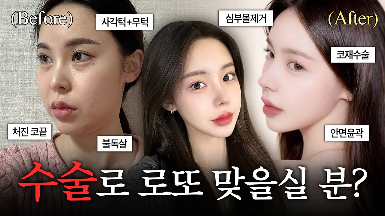 뼈 안 깎은 줄? 사각턱·코재수술 레전드 변신 🤫✨