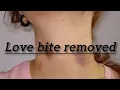 how to remove hickey love bite removed how to hide love bite