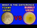 Differences between Foamy Urine Vs Bubbly Urine