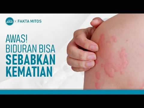 Bentol karena Biduran Bisa Fatal, Ini Penyebab dan Cara Mengatasinya