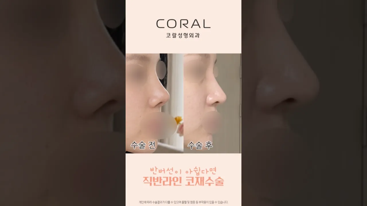 옆태 미인 소리 듣는 콧대+코끝 '직반라인' 전후 차이 ✨ #shorts #코재수술 #직반라인 #코성형전후