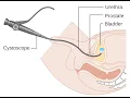 Cystourethroscopy with biopsy CPT code - simplify medical coding
