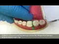 Rhondium Deep Margin Elevation Wedges by Dr Simon McDonald - Dental Deep Proximal Box Wedge