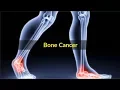 Bone Cancer Symptoms – Pictures, Causes and Symptoms of Bone Cancer in Men women