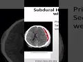 SUBDURAL HEMATOMA WITH SHIFT