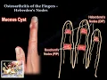 Lagu Osteoarthritis Of The Fingers Heberden's Nodes  - Everything You Need To Know - Dr. Nabil Ebraheim
