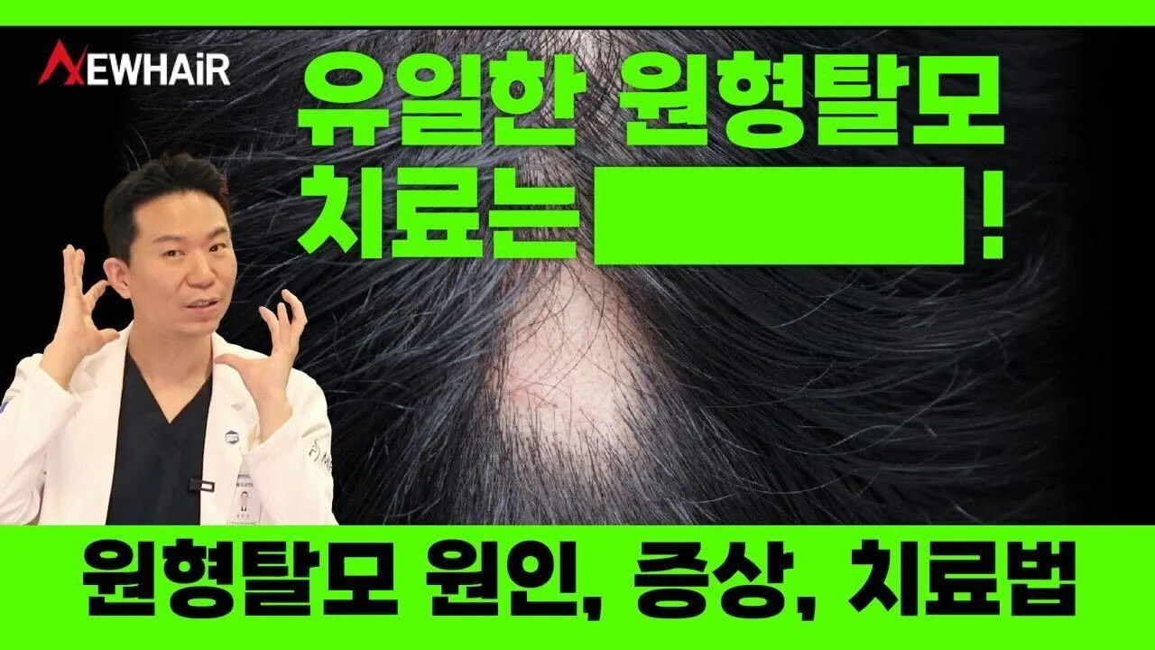 원형탈모는 꼭 병원에 가야 할까? 원인과 치료법!|뉴헤어
