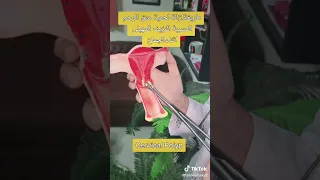 طريقة ازالة لحمية عنق الرحم المسببة للنزيف المهبلى اثناء الجماع د فاطمة التركى استشارى النساء  طريقة ازالة لحمية عنق الرحم المسببة للنزيف المهبلى اثناء الجماع د فاطمة التركى استشارى النساء