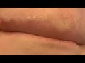 how to get rid of blackheads on lip line fast