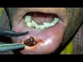 Download Lagu Traumatic Lower Lip Myiasis—A Rare Presentation