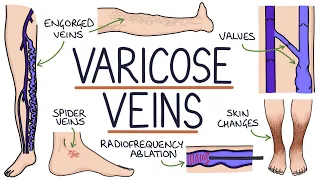 Download Understanding Varicose Veins MP3